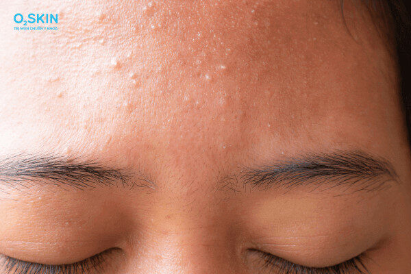 alt text: Hình ảnh minh họa mụn cám ở trán