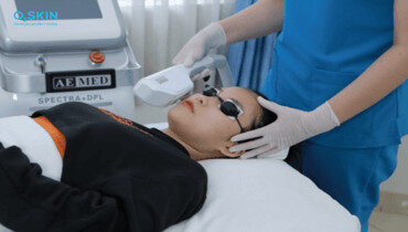 alt text: Hình ảnh minh họa mụn do stress