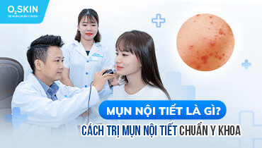 alt text: Hình ảnh minh họa mụn nội tiết