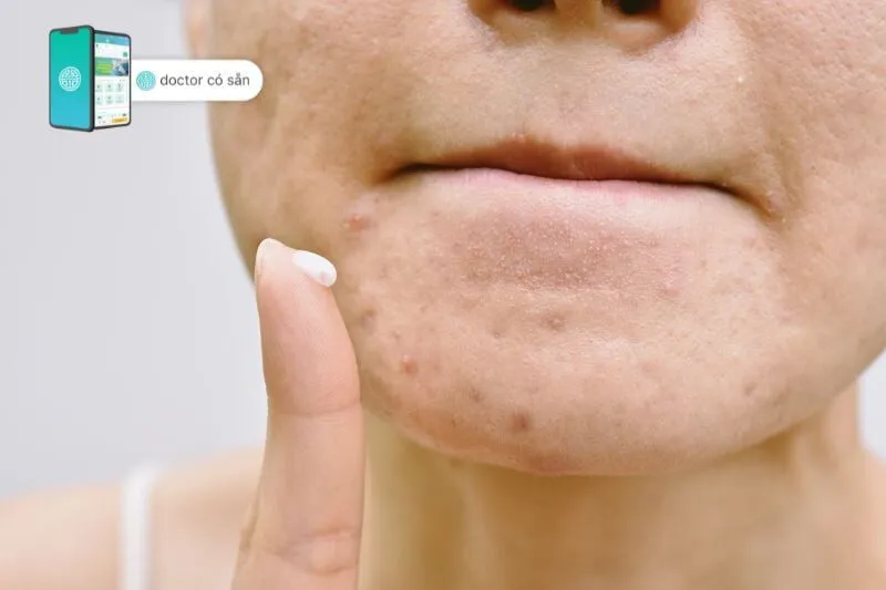 Mụn đinh râu là gì? Nguyên nhân và cách chữa trị khi bị mụn đinh