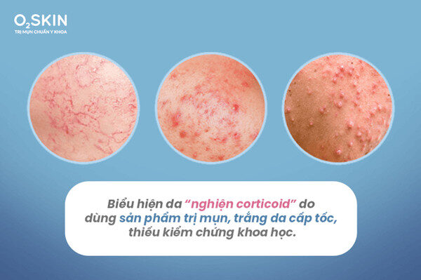 alt text: Lạm dụng sản phẩm trị mụn cấp tốc