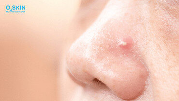 alt text: Thức khuya có thể gây mụn