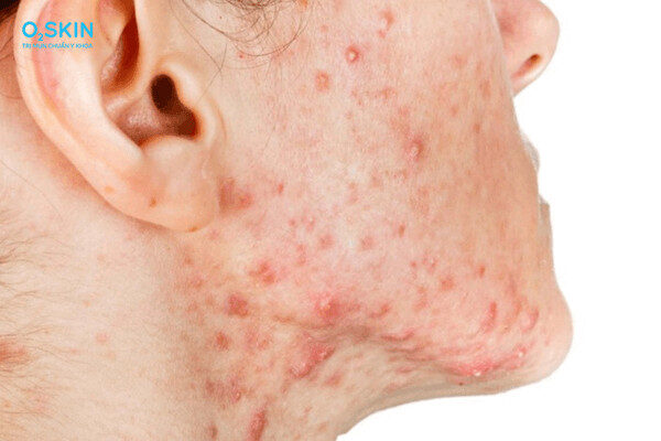 alt="Nguyên nhân nổi mụn ở quai hàm nữ giới"