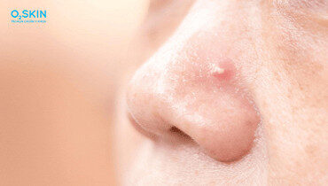 alt="Vị trí mụn trên mặt"