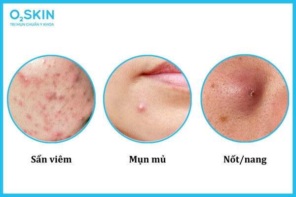 Các loại mụn viêm thường gặp là sẩn viêm, mụn mủ, nốt, nang.