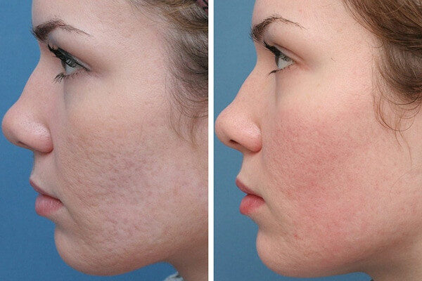 Các phương pháp trị sẹo rỗ hiệu quả