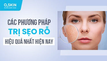 Các phương pháp trị sẹo rỗ hiệu quả nhất hiện nay