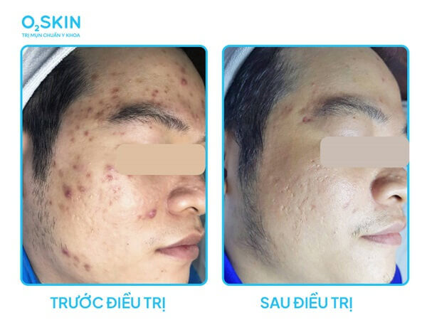 Chỉ sau 1 tháng điều trị,  làn da đã được cải thiện rõ rệt, không còn mụn viêm, mụn đầu đen và da đã khỏe hơn trước nhiều.