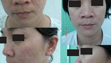 Hình ảnh minh họa lăn kim trị sẹo rỗ