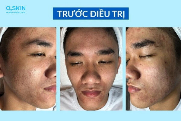 Kết quả điều trị mụn