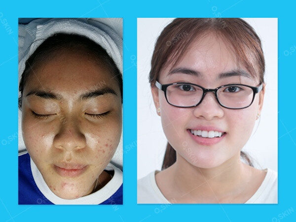 Làn da trước và sau khi peel