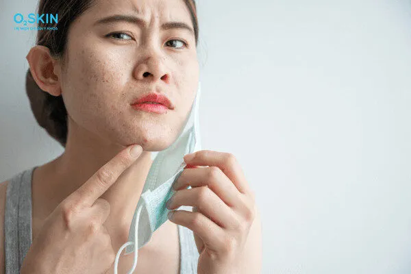10 cách trị sẹo rỗ hiệu quả tại nhà từ nguyên liệu tự nhiên