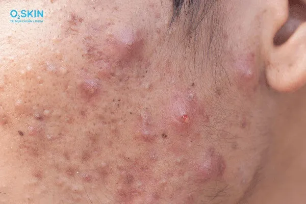 Mụn mạch lươn là gì? Nguyên nhân và cách điều trị hiệu quả