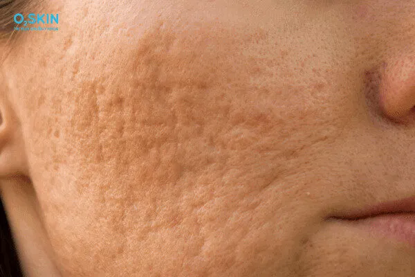 Sẹo mụn có tự hết không? Làm thế nào để hết sẹo mụn?