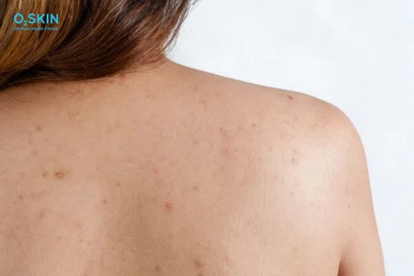 Mụn ẩn ở lưng do đâu? Cách điều trị và phòng ngừa hiệu quả