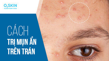 Mụn ẩn trên trán