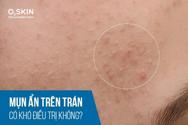 Mụn ẩn trên trán do đâu? Cách trị mụn ẩn trên trán hiệu quả từ đầu