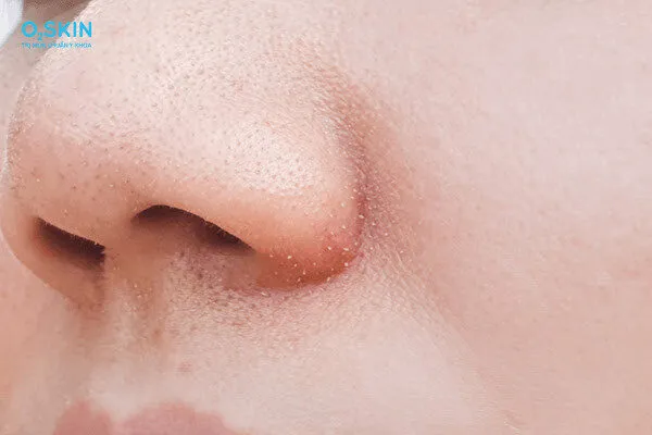 Mụn cám ở mũi – Nguyên nhân, Cách điều trị và Chăm sóc hiệu quả