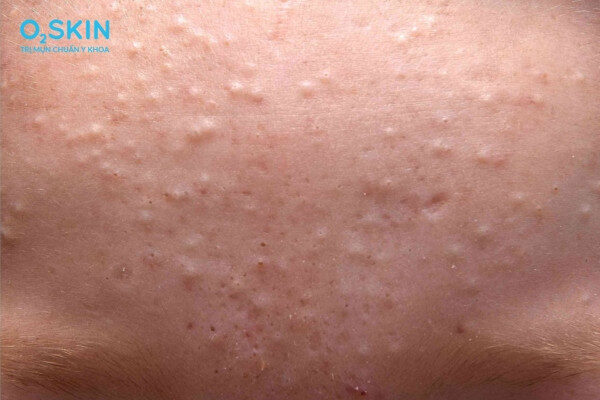 Mụn đầu trắng trên da