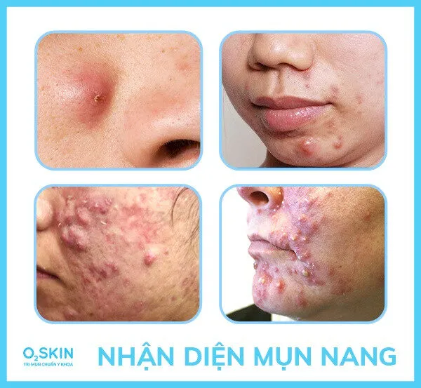 5 Sai Lầm Thường Gặp Khiến Mụn Nang Thêm Trầm Trọng