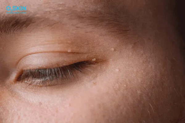 8 cách trị mụn thịt hiệu quả, nhanh chóng bạn nên nắm rõ