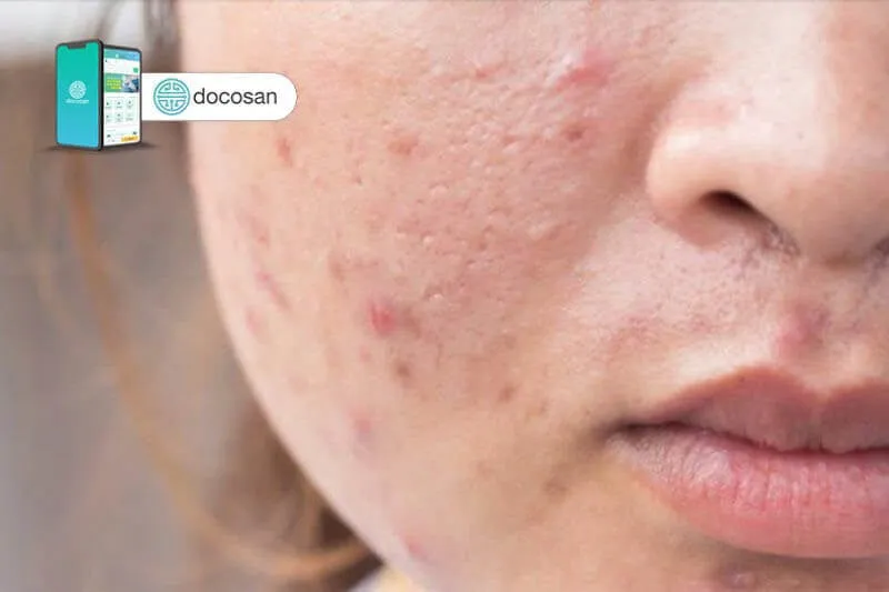 Mụn trứng cá: Phân loại, nguyên nhân, cách điều trị