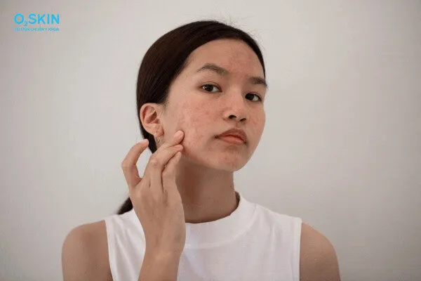 Mụn trứng cá là gì? Tìm hiểu nguyên nhân, dấu hiệu và cách điều trị
