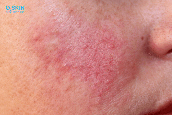 Mụn trứng cá đỏ thể giãn mạch với biểu hiện đỏ da và cảm giác châm chích