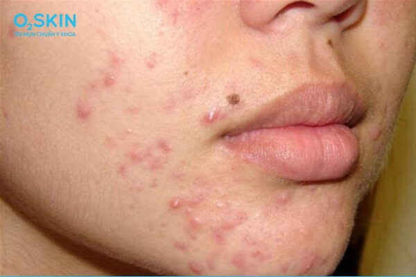 Mụn viêm ở má, cằm, trán, mũi không chỉ mất thẩm mỹ mà còn gây sưng đau khó chịu.