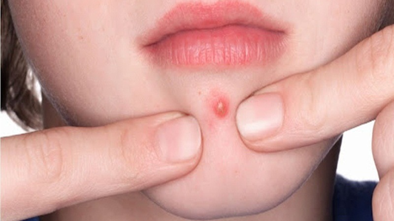 Hình ảnh mụn đinh râu