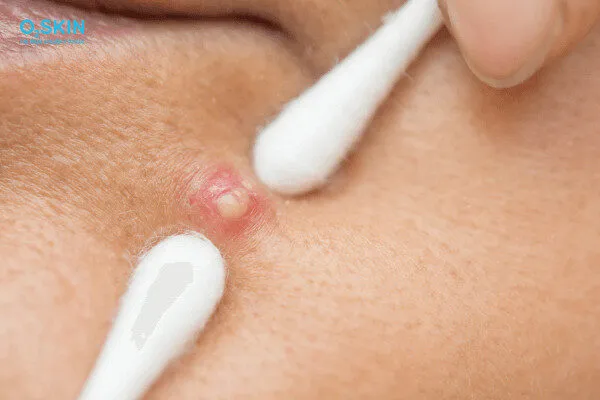 Có nên nặn mụn không? Quy trình nặn mụn đúng cách ngừa thâm sẹo