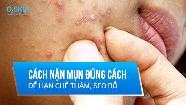 Nặn mụn sai cách