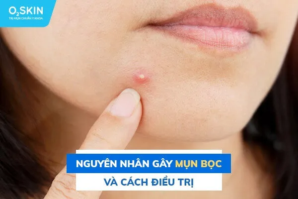 Mụn bọc là gì? Nguyên nhân, dấu hiệu và cách điều trị
