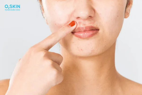 9 nguyên nhân gây mụn phổ biến, có thể bạn đang mắc phải