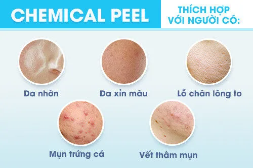 Peel da hóa học là gì? Có nên peel da hóc học?