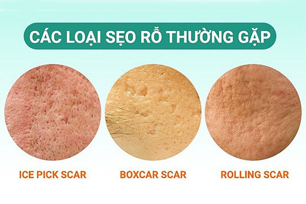 Phân loại sẹo rỗ