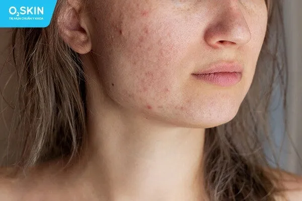 Đẩy mụn là gì? Hiểu đúng quá trình đẩy mụn để trị mụn hiệu quả