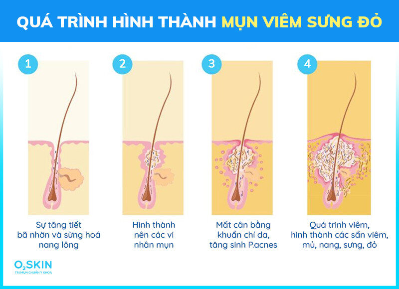 Quá trình hình thành mụn viêm sưng đỏ qua 4 giai đoạn.