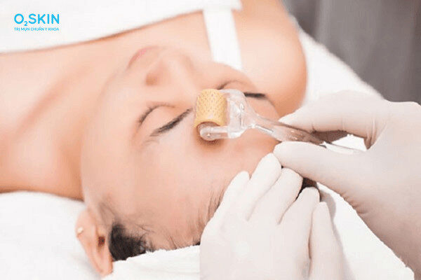 Quy trình lăn kim trị sẹo rỗ