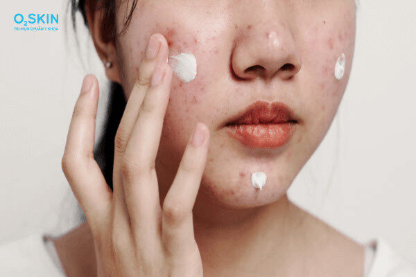 Sản phẩm không phù hợp gây mụn