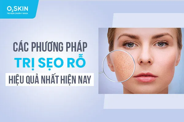 Các phương pháp trị sẹo rỗ hiệu quả nhất hiện nay