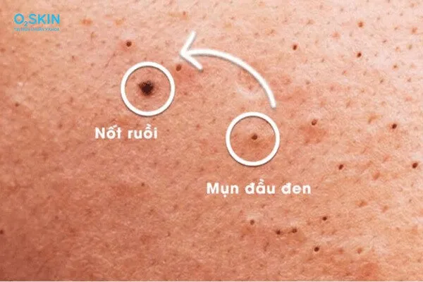 Mụn đầu đen để lâu có thành nốt ruồi không?