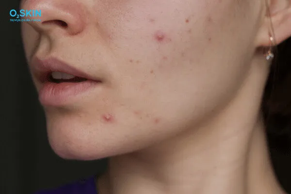 Thâm đỏ sau mụn: Nguyên nhân và cách điều trị hiệu quả